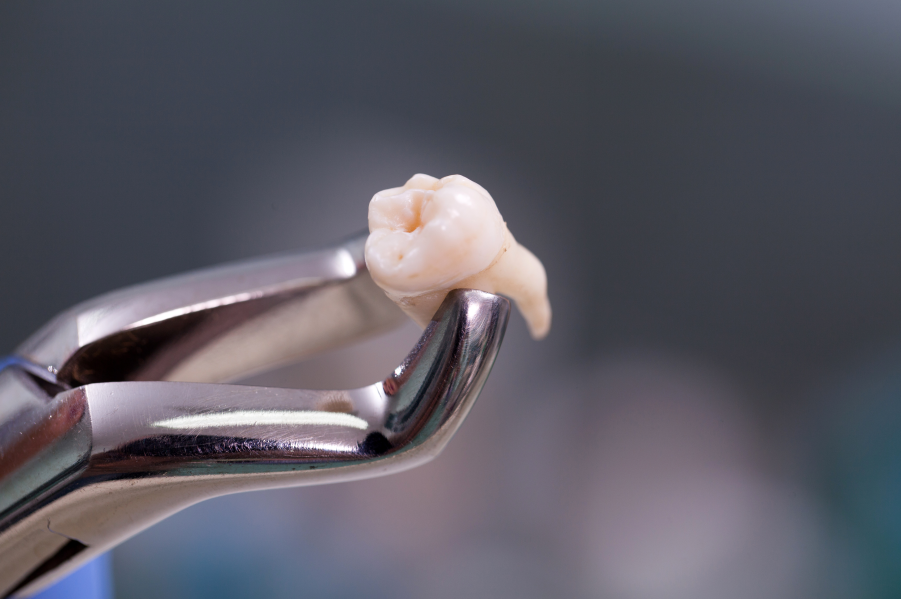 3 cuidados básicos após uma extração de dente - Odontologia do Povo